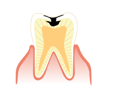 象牙質まで進んだ虫歯