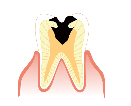 歯髄まで進んだ虫歯