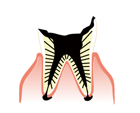 歯冠がこわれ、歯の根が残った虫歯
