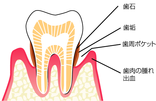 歯周病（歯槽膿漏）